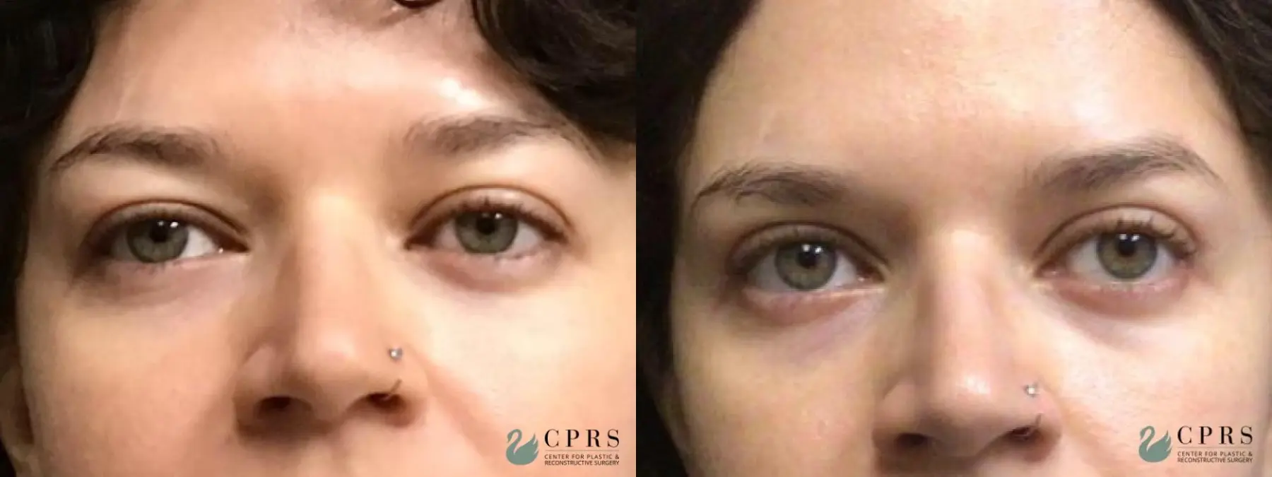 Blepharoplasty: Patient 9 - Before and After  