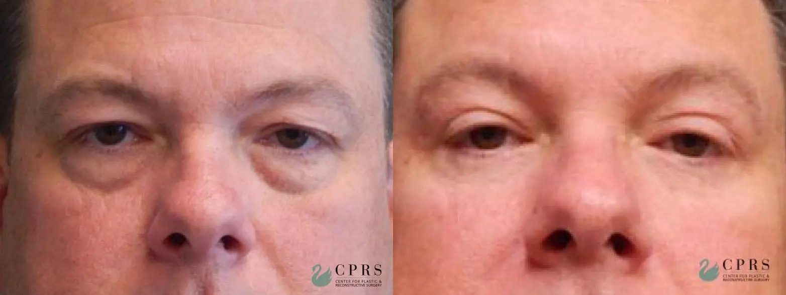 Blepharoplasty: Patient 8 - Before and After  