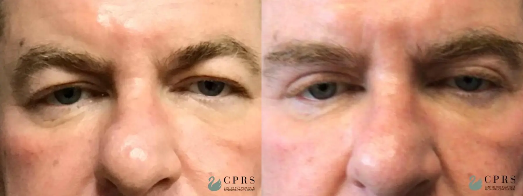 Blepharoplasty: Patient 13 - Before and After  