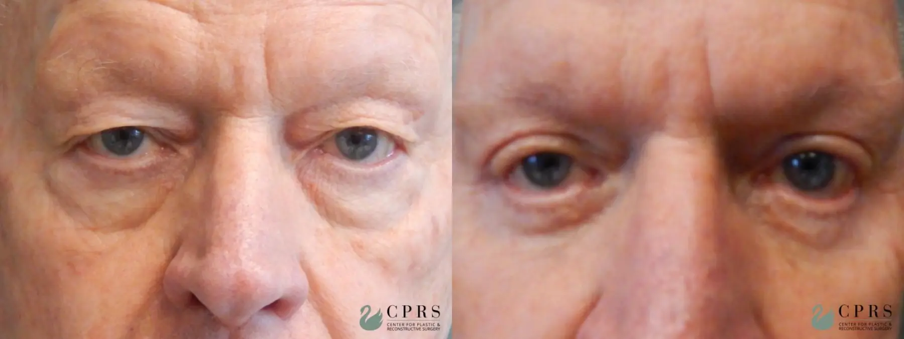 Blepharoplasty: Patient 7 - Before and After  