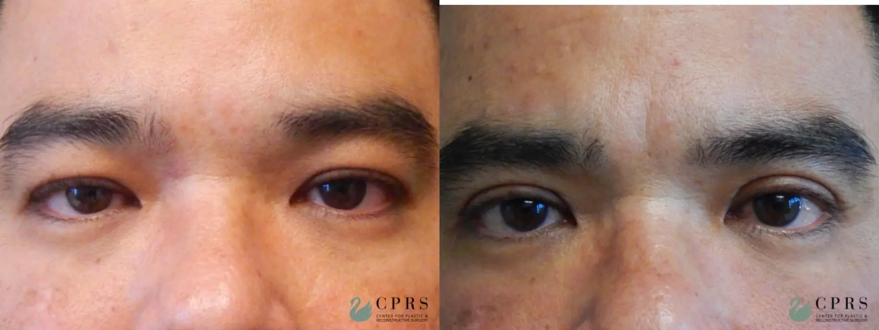 Blepharoplasty: Patient 3 - Before and After  