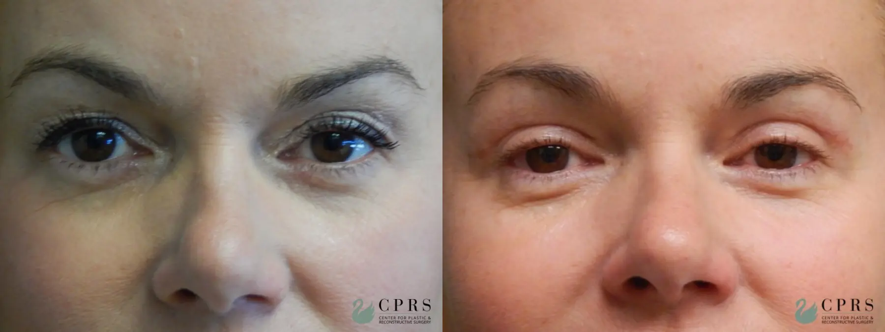 Blepharoplasty: Patient 1 - Before and After  