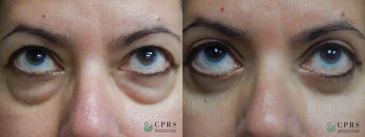 Blepharoplasty: Patient 3 - Before and After  