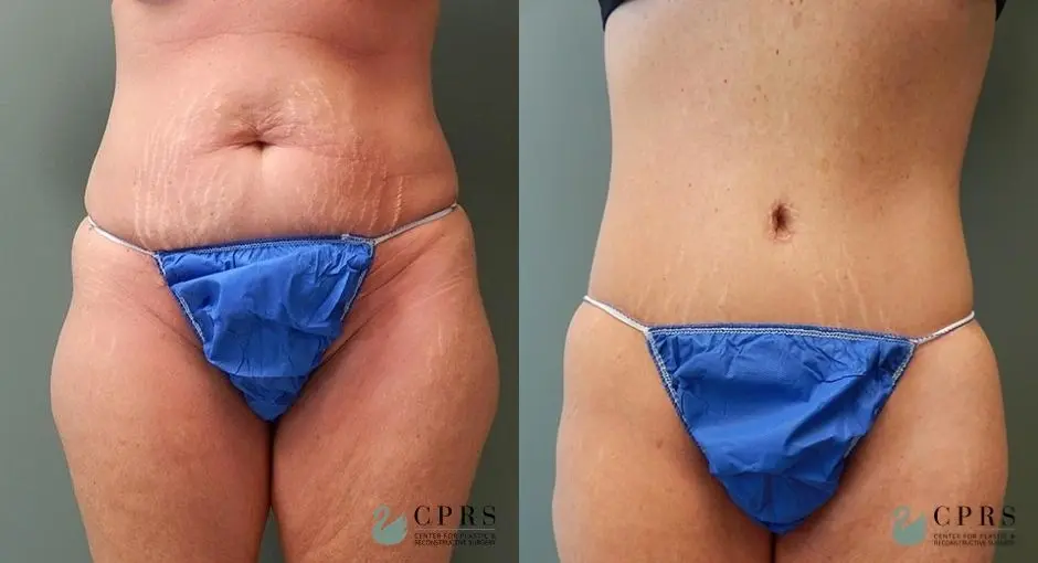 Body Lift: Patient 1 - Before and After  