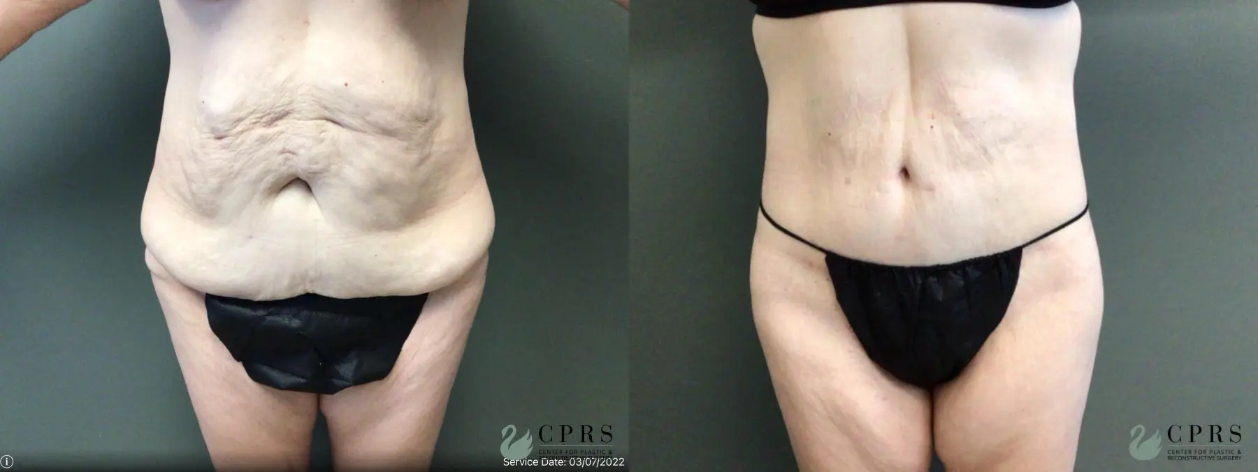 Body Lift: Patient 3 - Before and After  