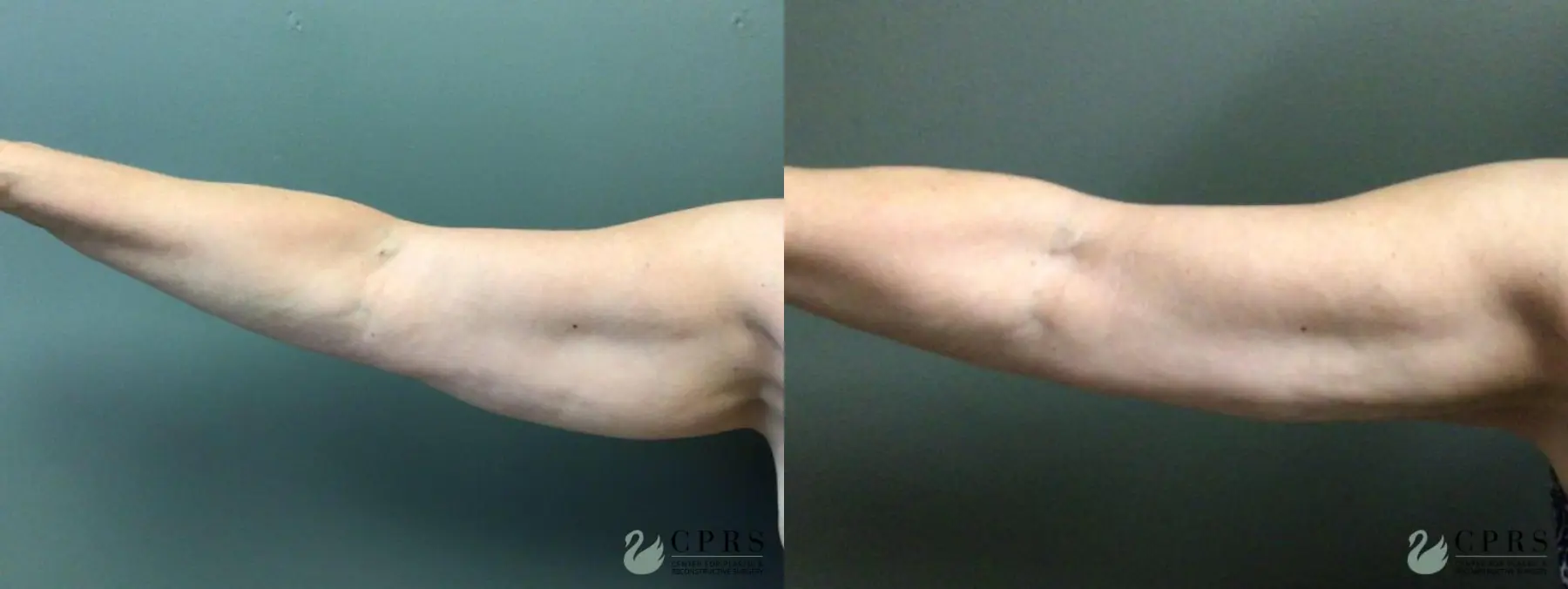 BodyTite: Patient 1 - Before and After  