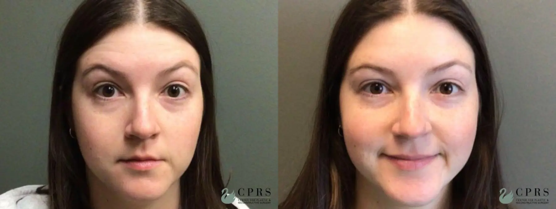BOTOX® Cosmetic: Patient 1 - Before and After  