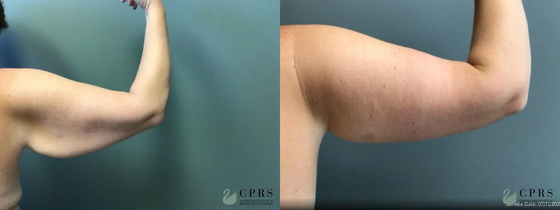 Brachioplasty: Patient 7 - Before and After  