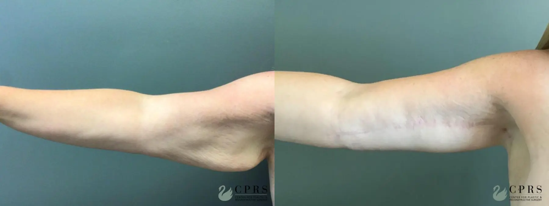 Brachioplasty: Patient 5 - Before and After  