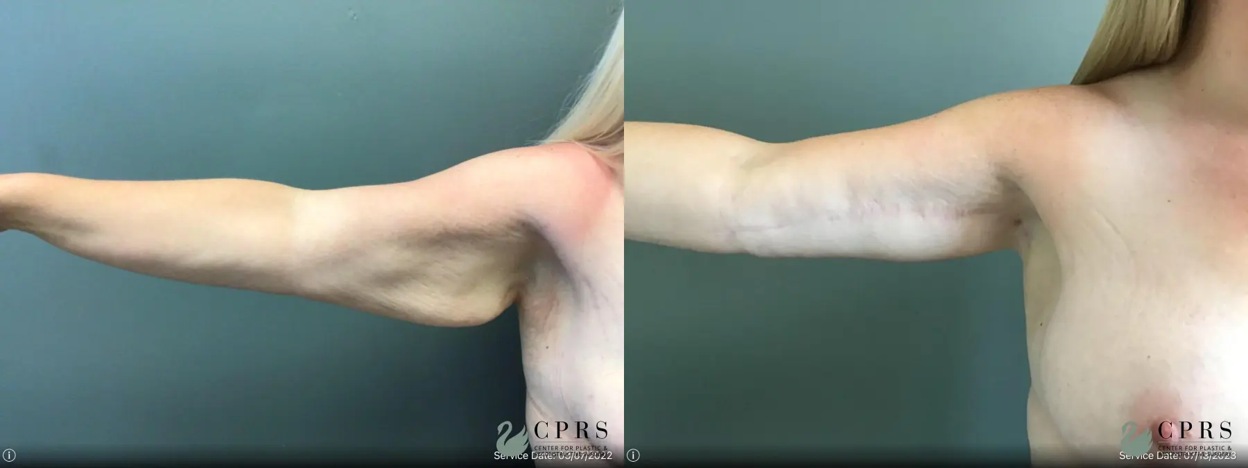 Brachioplasty: Patient 4 - Before and After  