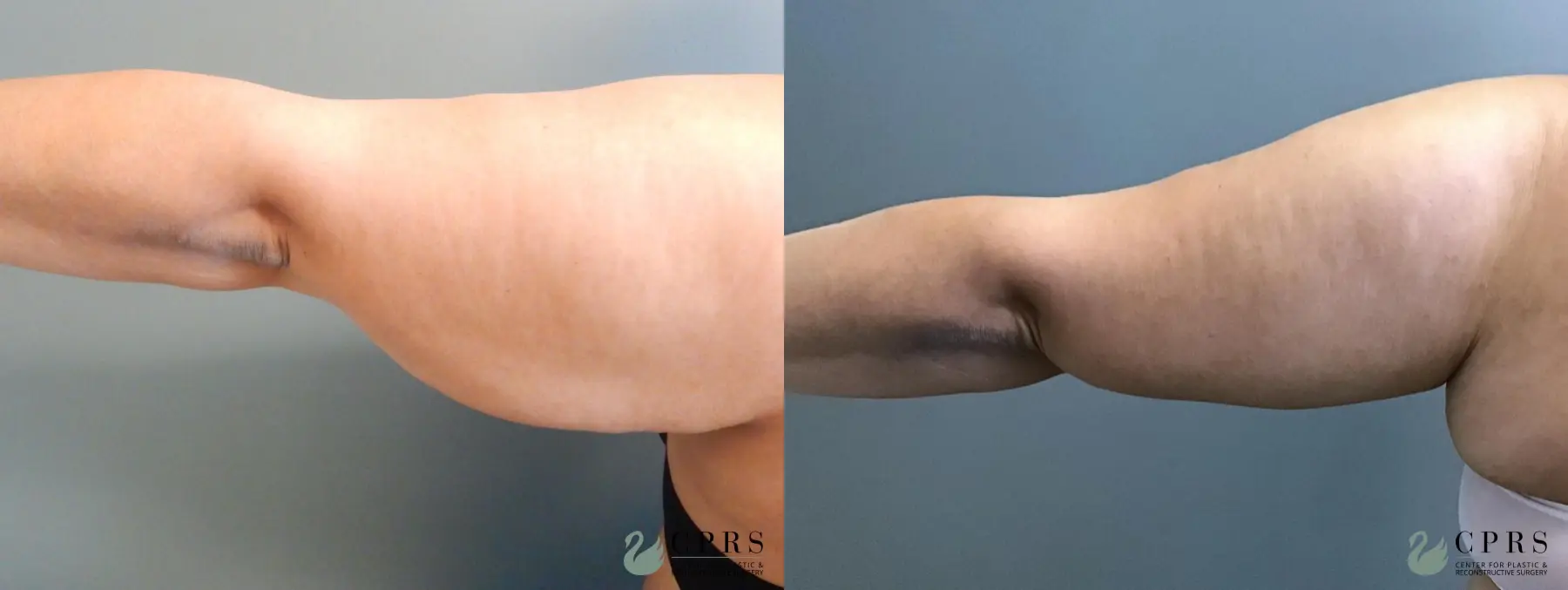 Brachioplasty: Patient 3 - Before and After  