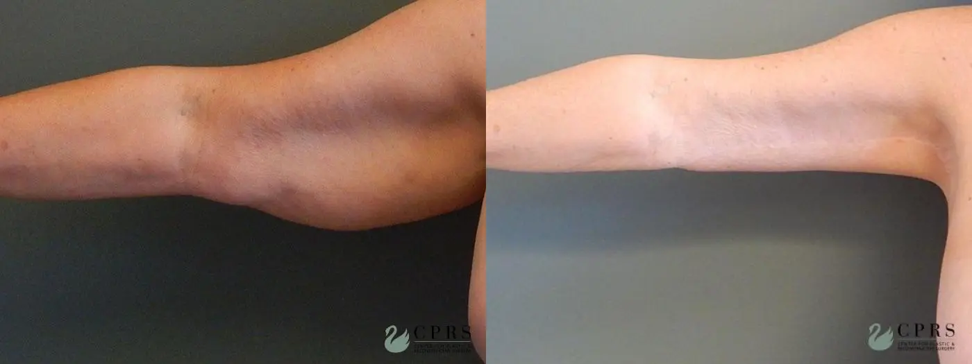 Brachioplasty: Patient 1 - Before and After  