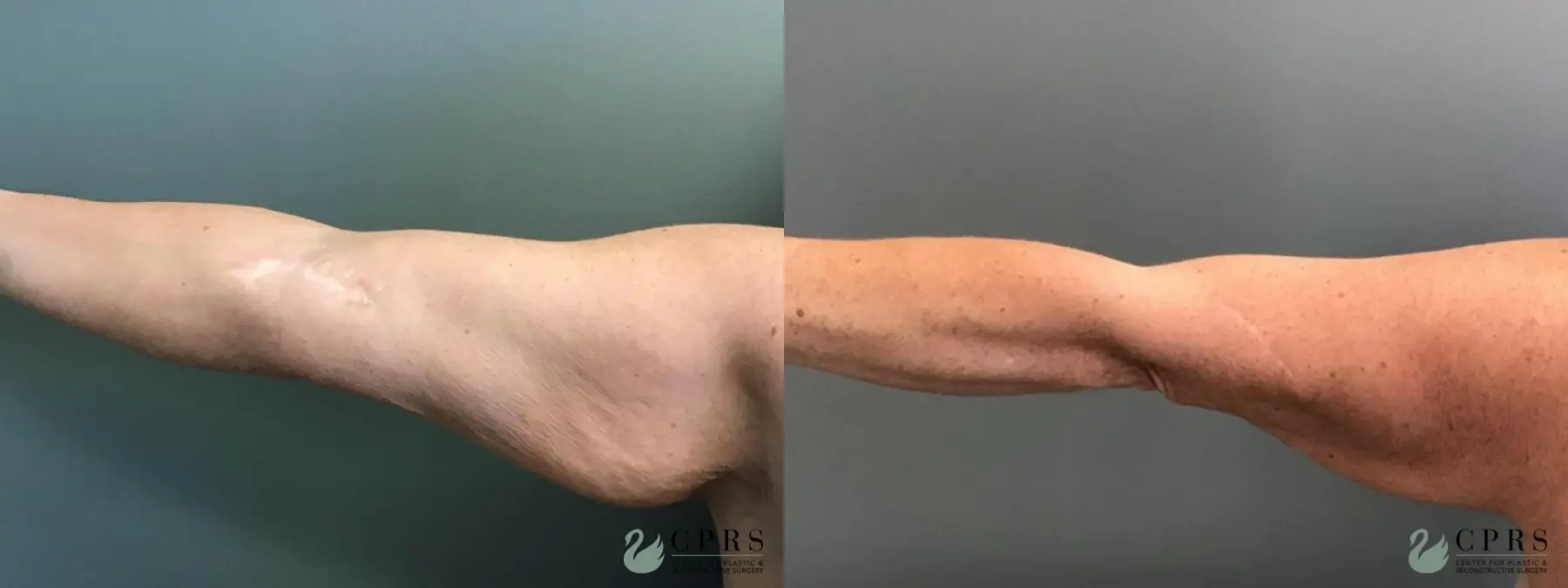 Brachioplasty: Patient 2 - Before and After  