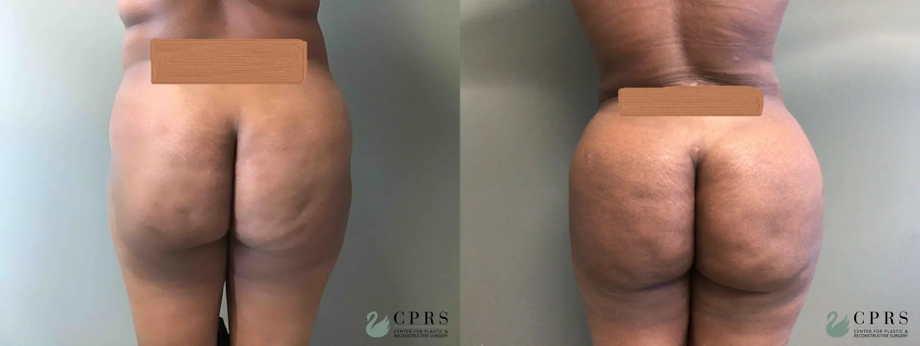 Brazilian Butt Lift: Patient 1 - Before and After  