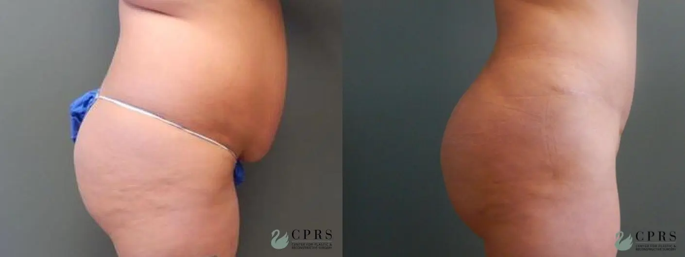 Brazilian Butt Lift: Patient 3 - Before and After  