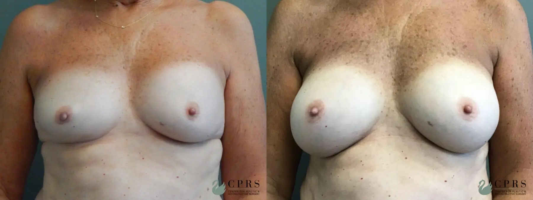 Breast Augmentation: Patient 11 - Before and After  