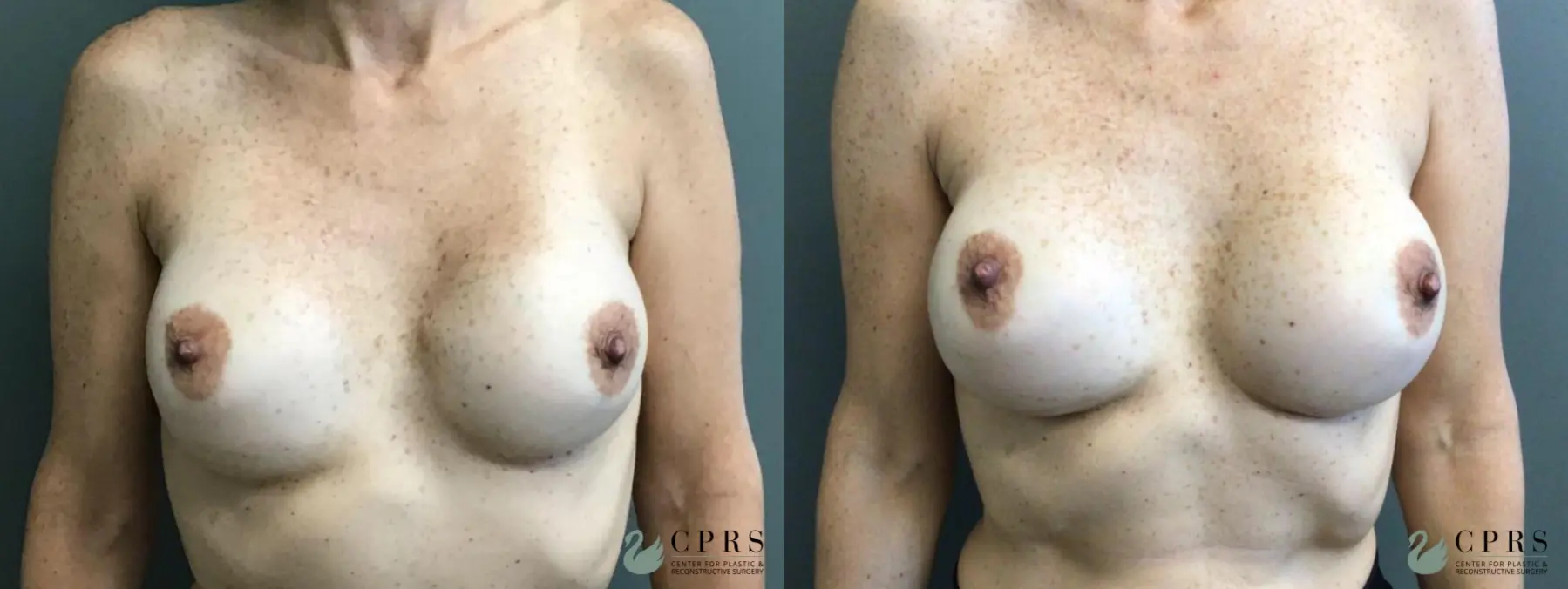 Breast Augmentation: Patient 9 - Before and After  