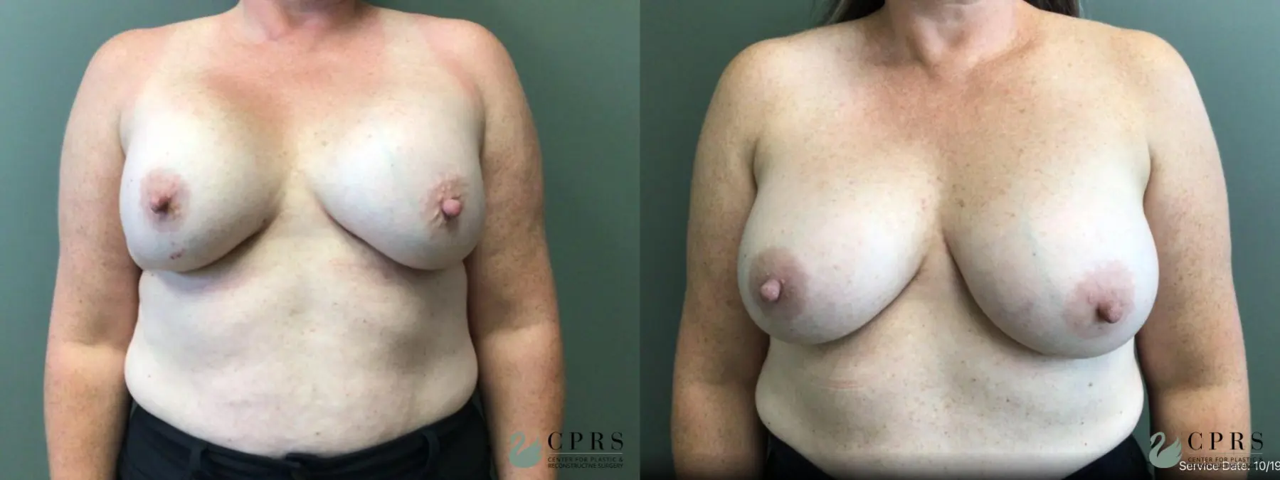 Breast Augmentation: Patient 19 - Before and After  