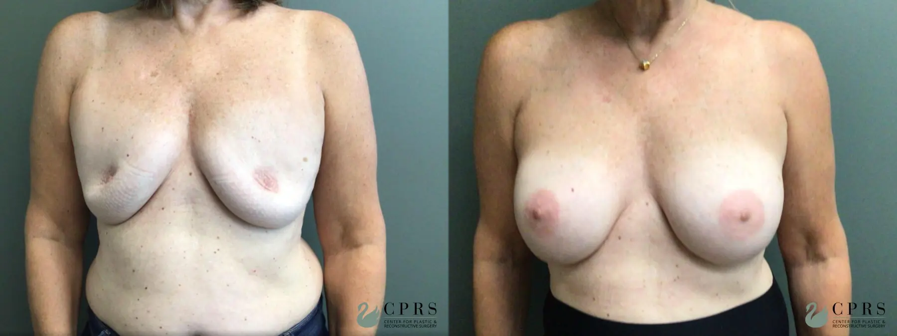 Breast Augmentation: Patient 22 - Before and After  