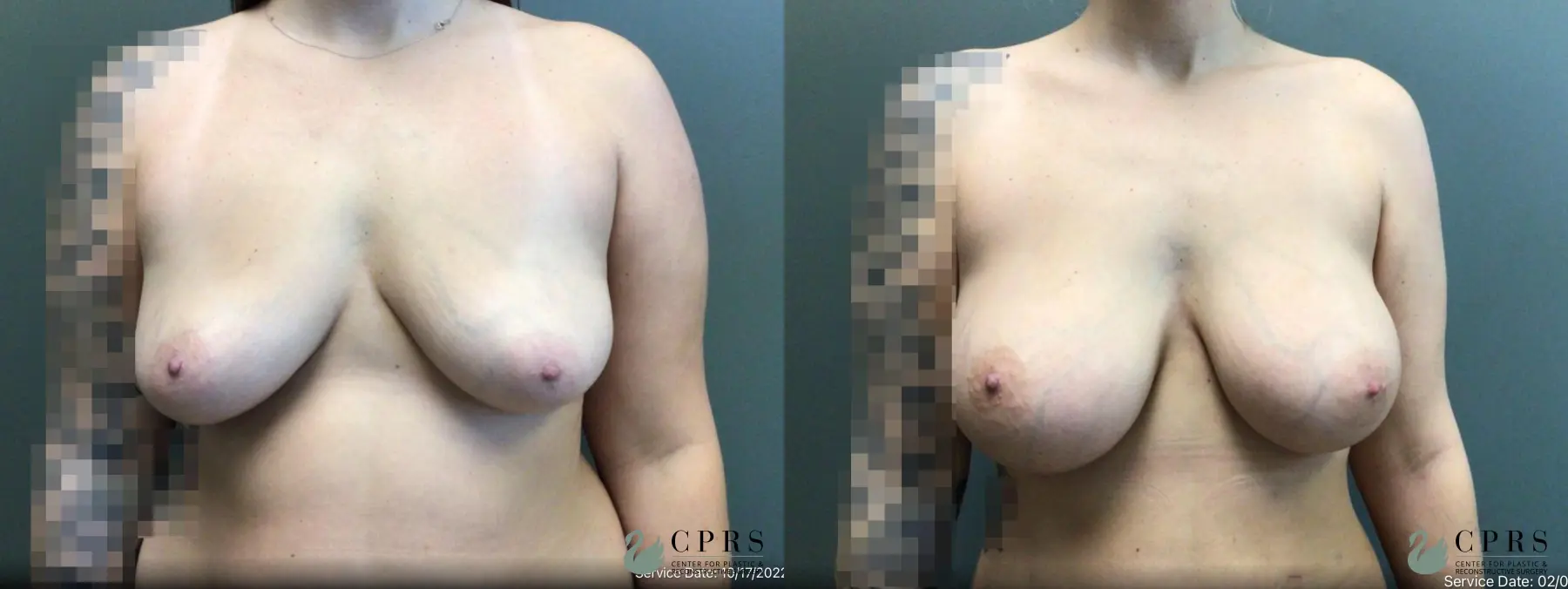 Breast Augmentation: Patient 21 - Before and After  