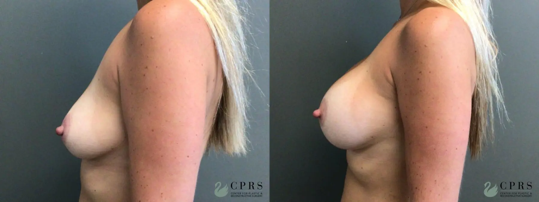Breast Augmentation: Patient 15 - Before and After 3