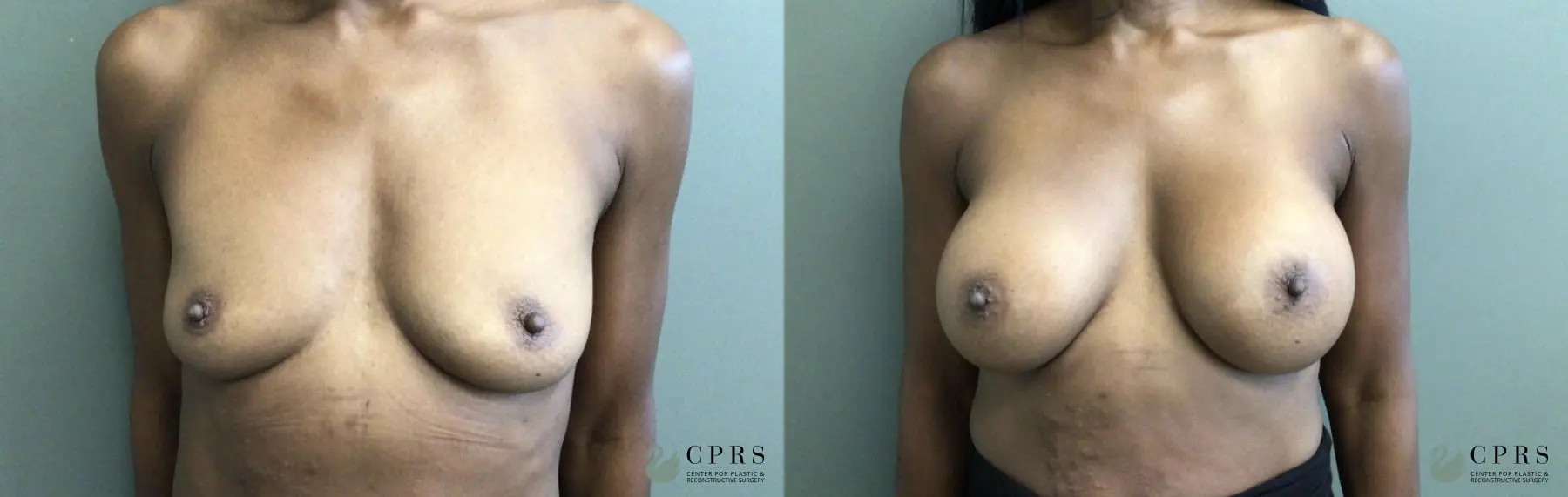 Breast Augmentation: Patient 14 - Before and After  