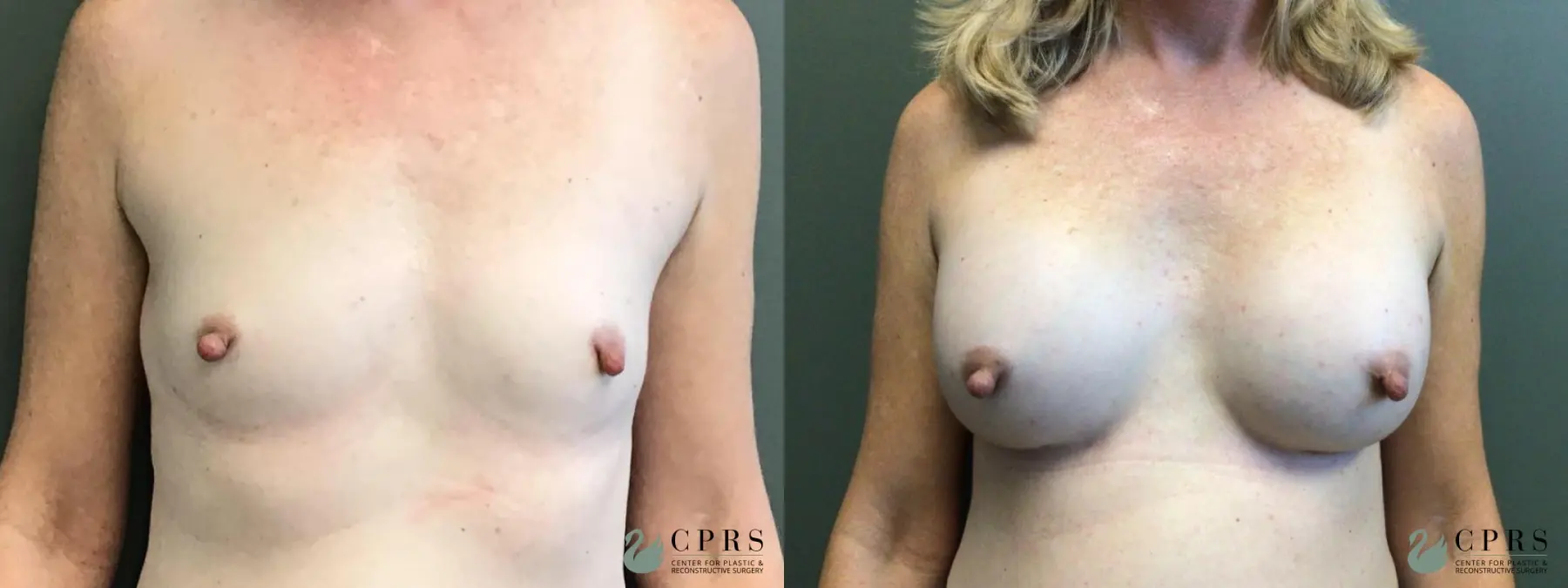 Breast Augmentation: Patient 10 - Before and After  