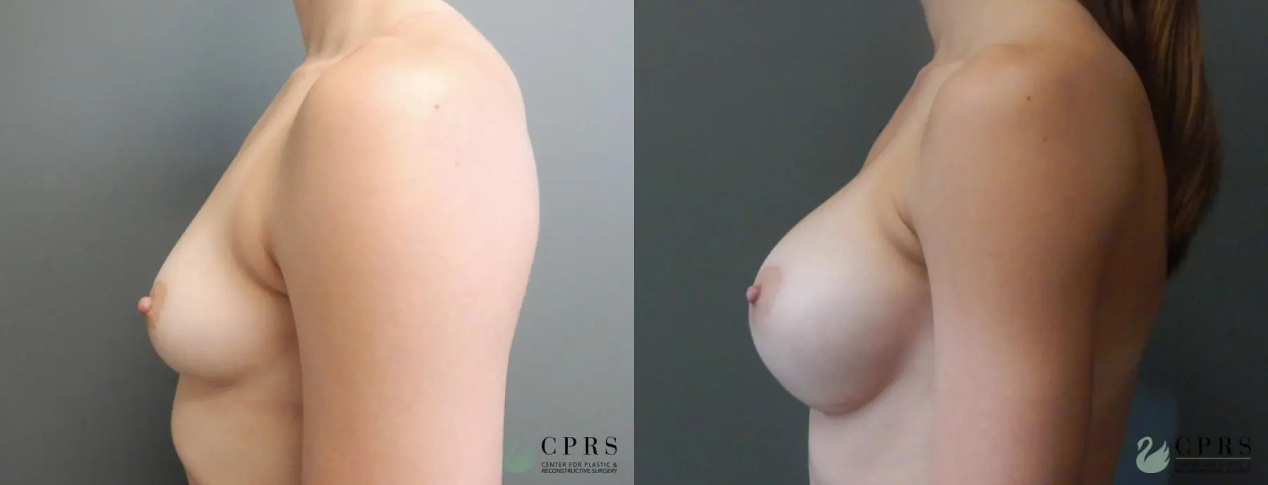 Breast Augmentation: Patient 12 - Before and After  