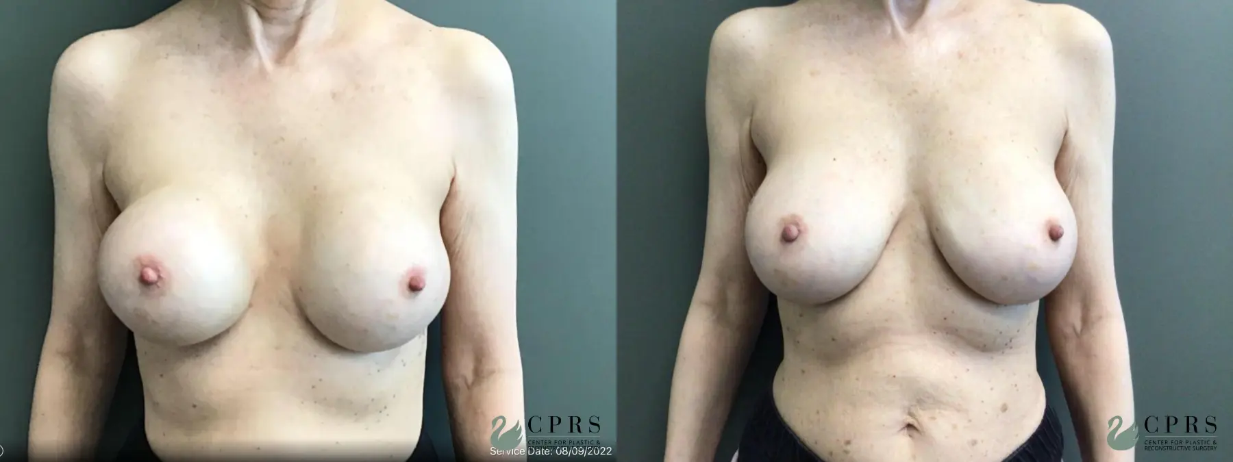 Breast Augmentation: Patient 25 - Before and After  