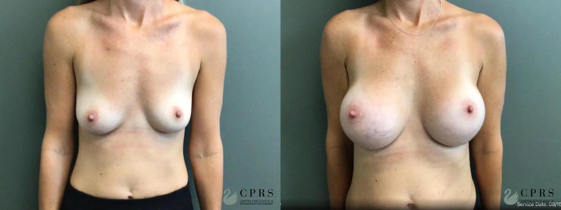 Breast Augmentation: Patient 27 - Before and After  