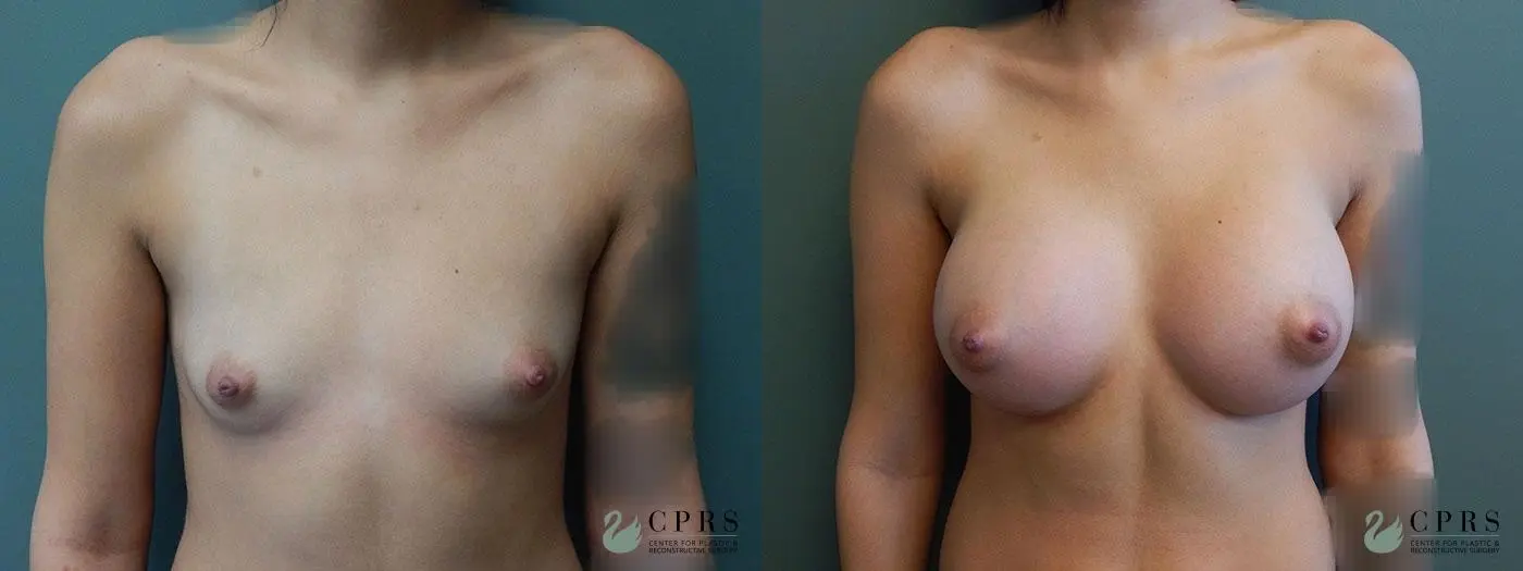 Breast Augmentation: Patient 2 - Before and After  