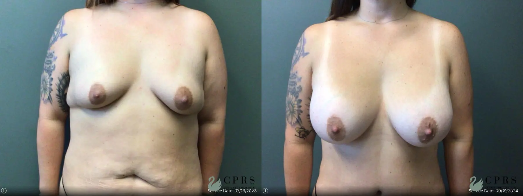 Breast Augmentation: Patient 26 - Before and After  