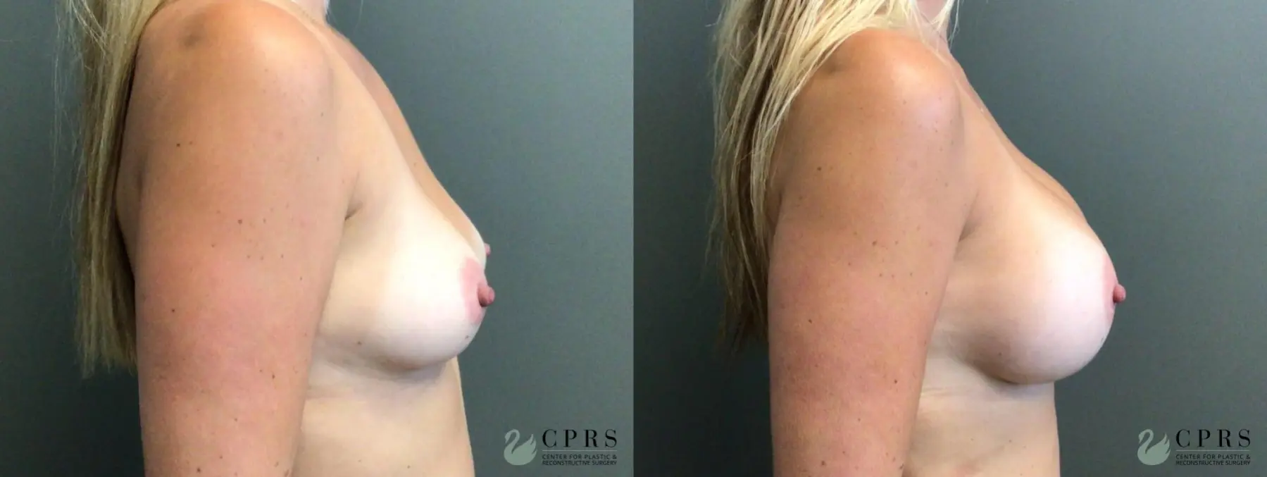 Breast Augmentation: Patient 15 - Before and After 2