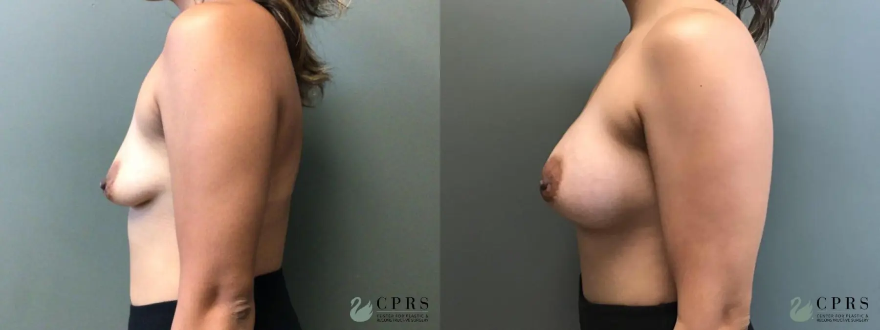 Breast Augmentation: Patient 16 - Before and After 3