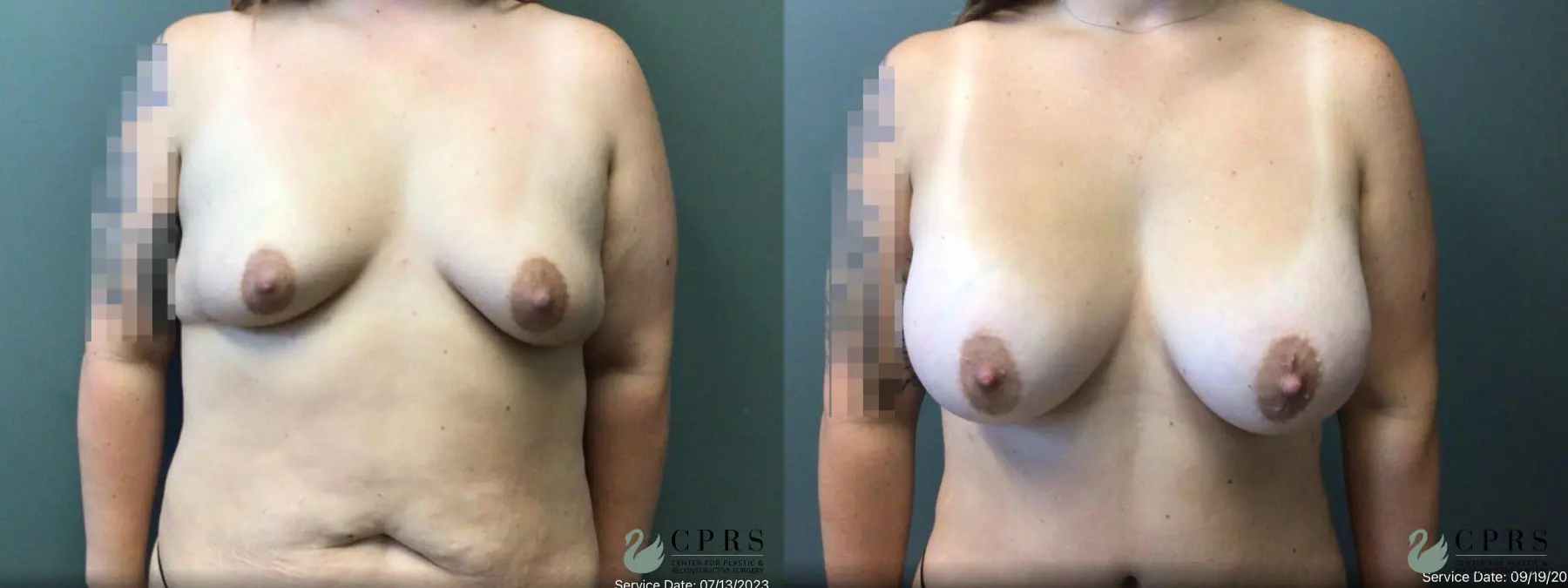 Breast Augmentation: Patient 22 - Before and After  