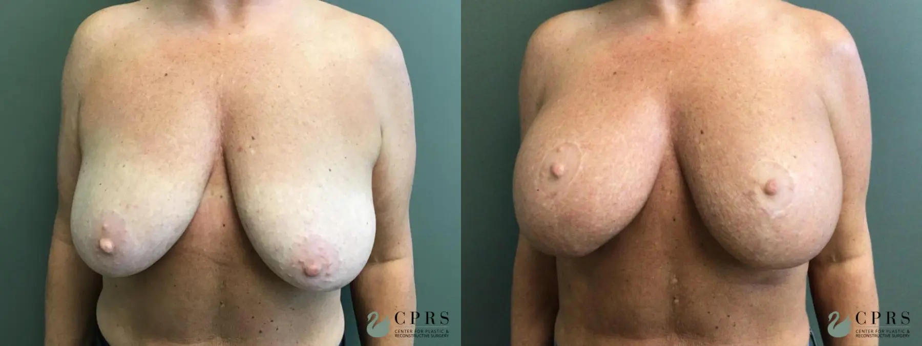 Breast Augmentation With Lift: Patient 3 - Before and After  