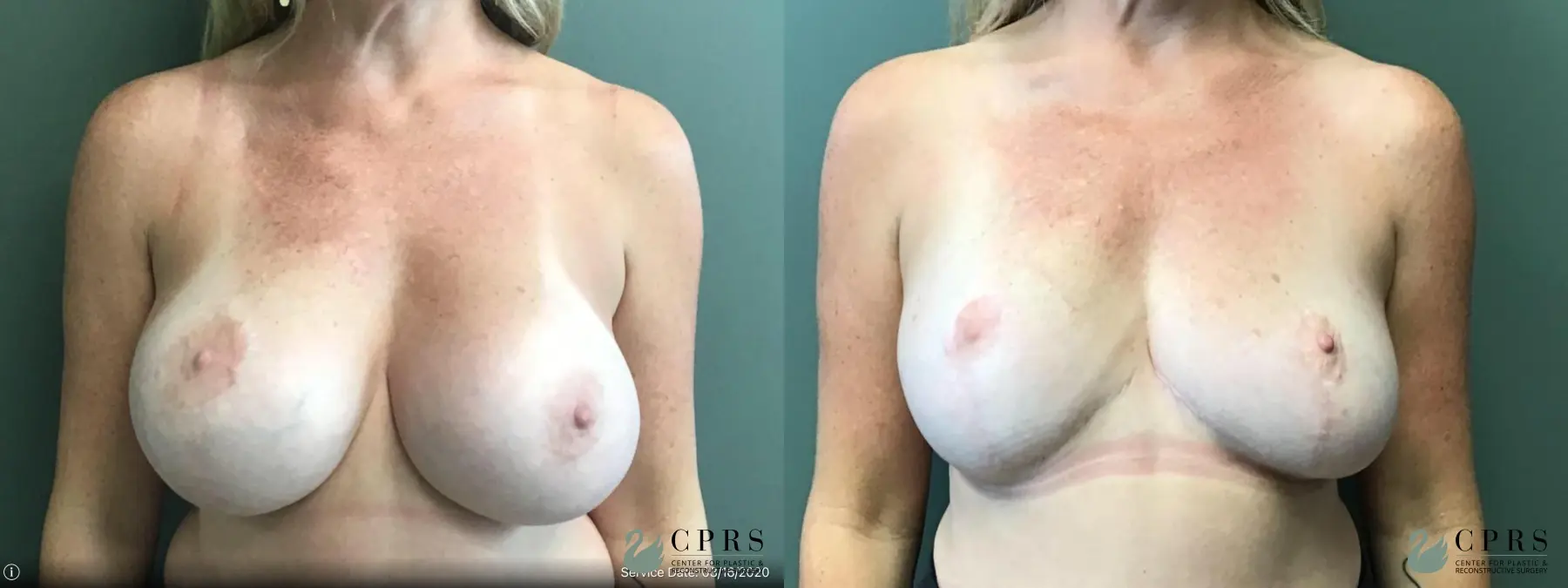 Breast Implant Removal With Lift: Patient 1 - Before and After 1