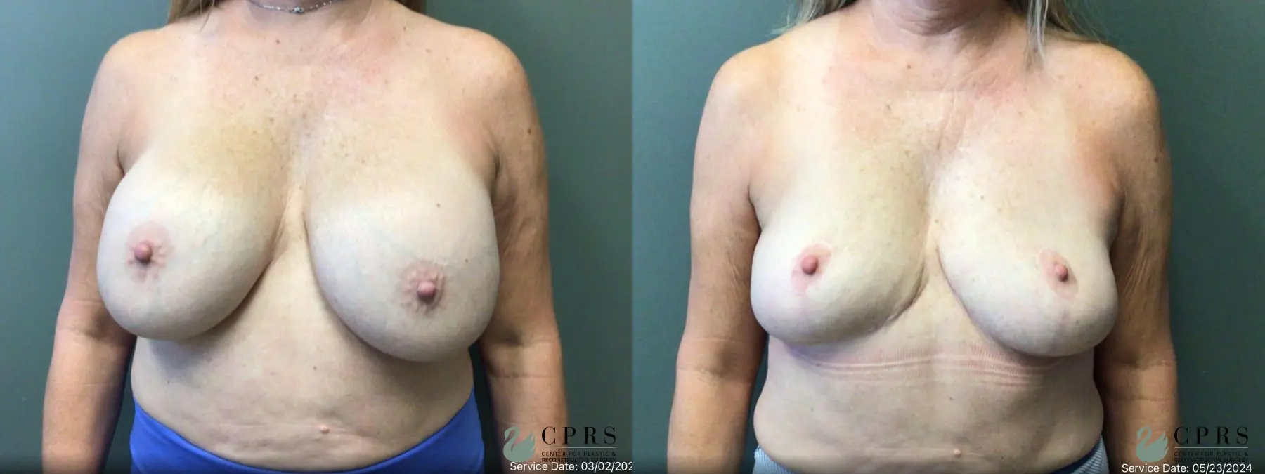 Breast Implant Removal With Lift: Patient 3 - Before and After  