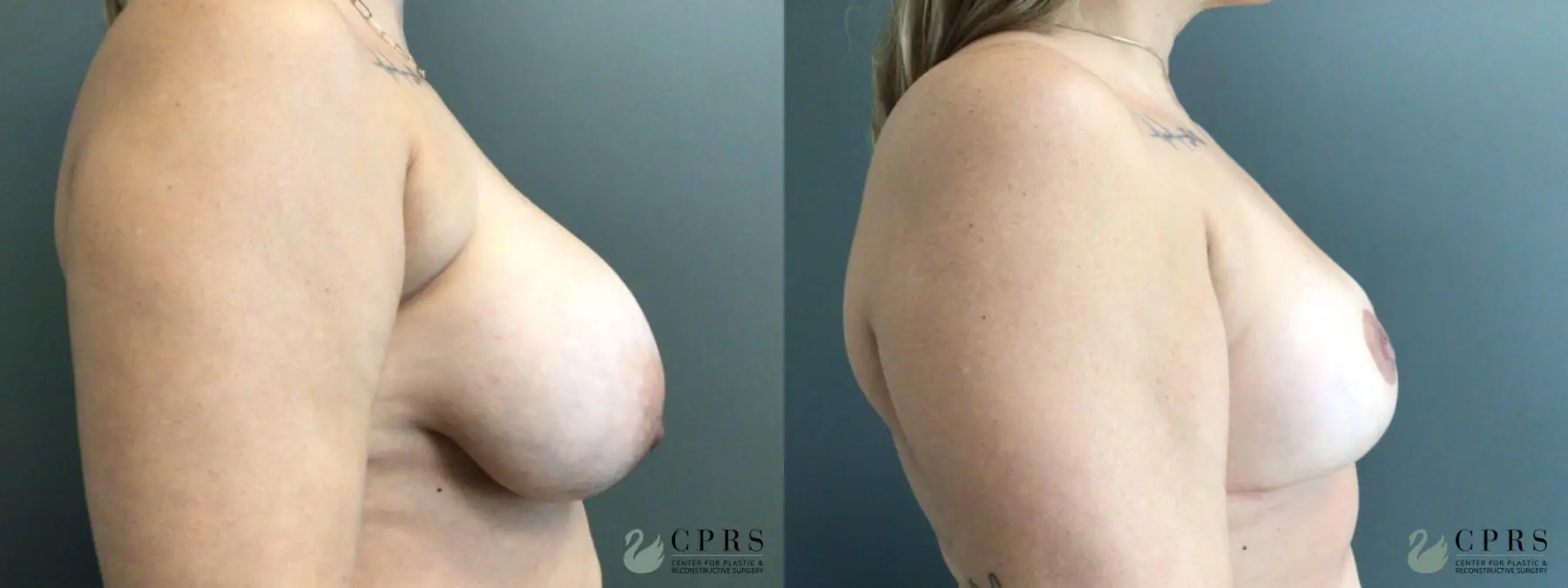 Breast Implant Removal With Lift: Patient 1 - Before and After  