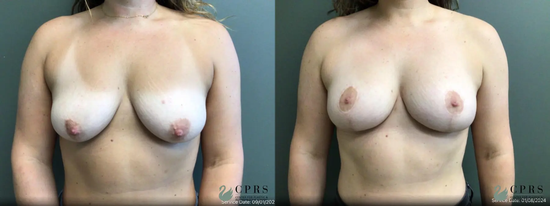 Breast Lift: Patient 8 - Before and After 1