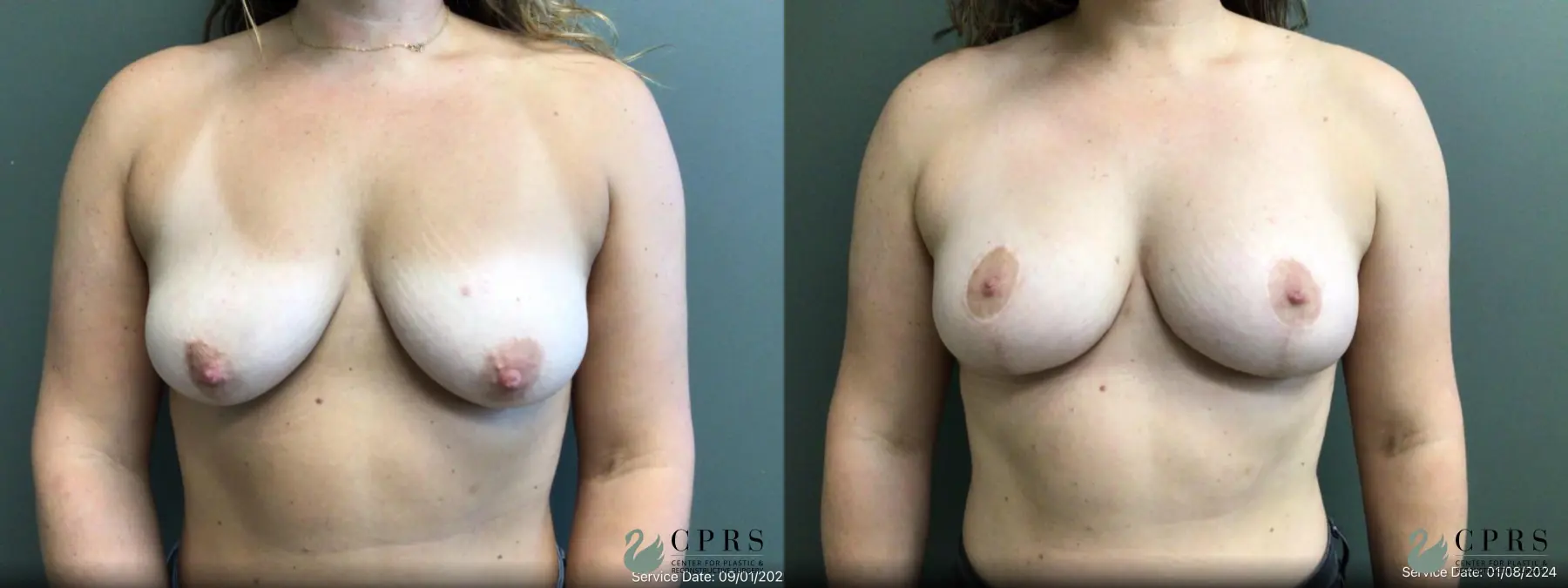 Breast Lift: Patient 8 - Before and After  