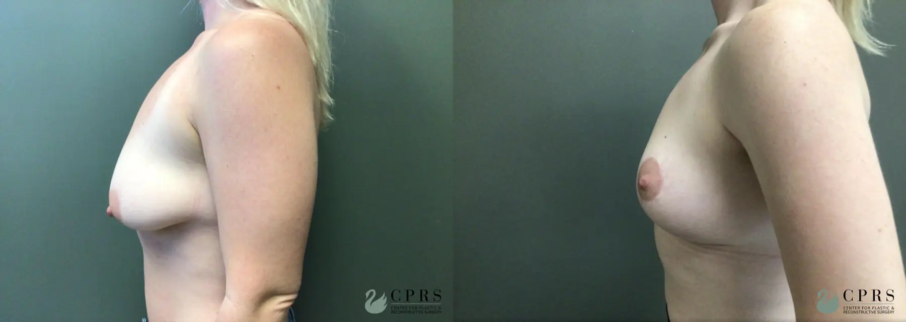 Breast Lift: Patient 7 - Before and After 3