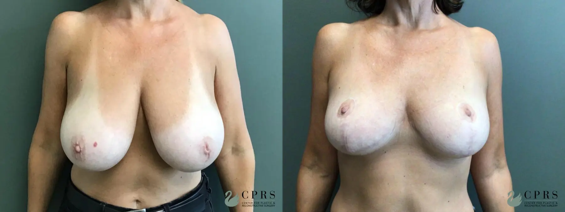 Breast Lift: Patient 5 - Before and After  