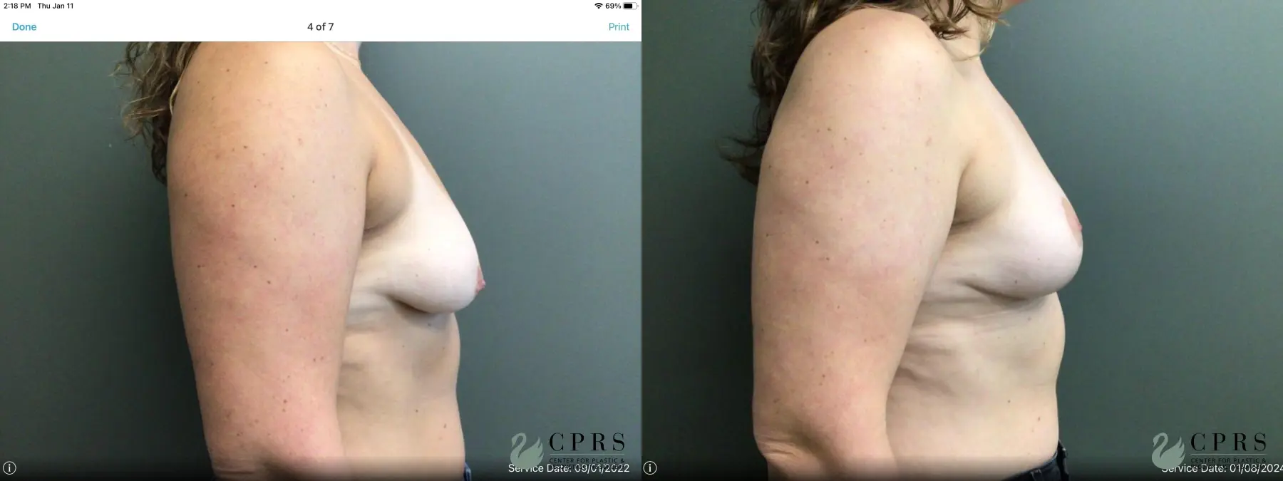 Breast Lift: Patient 8 - Before and After 2