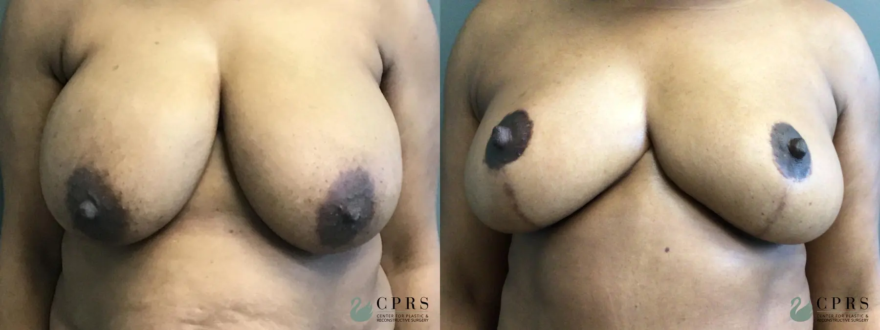 Breast Lift: Patient 2 - Before and After  