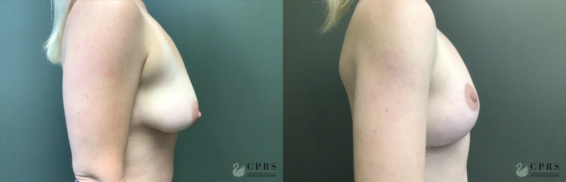 Breast Lift: Patient 6 - Before and After  