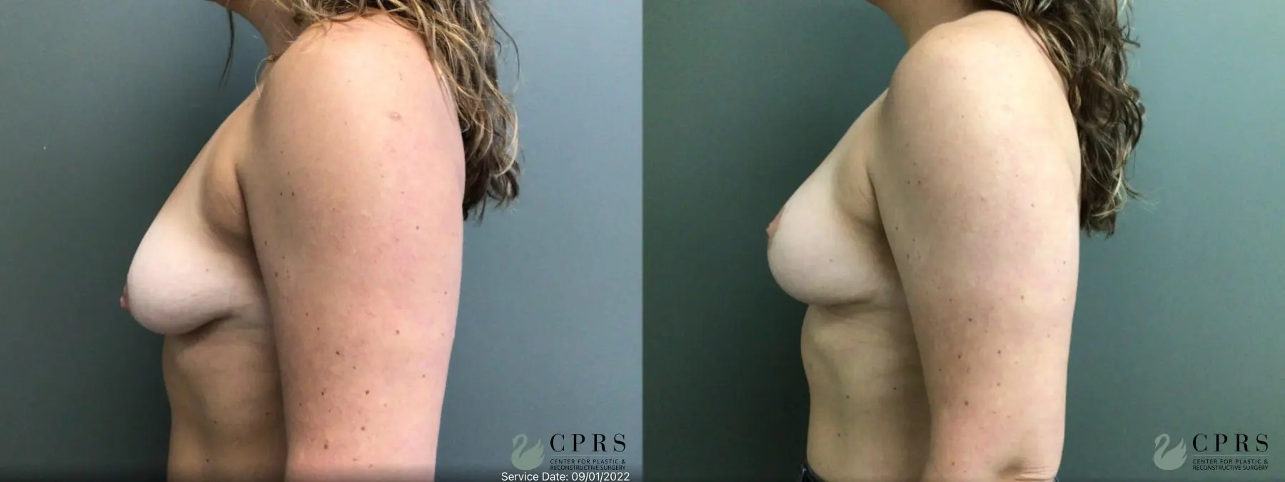 Breast Lift: Patient 8 - Before and After 3