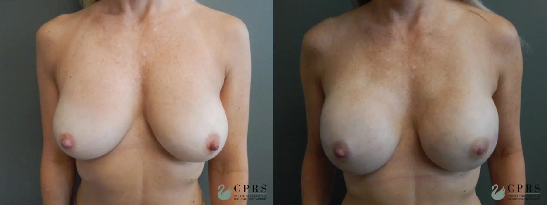 Breast Reconstruction: Patient 3 - Before and After  