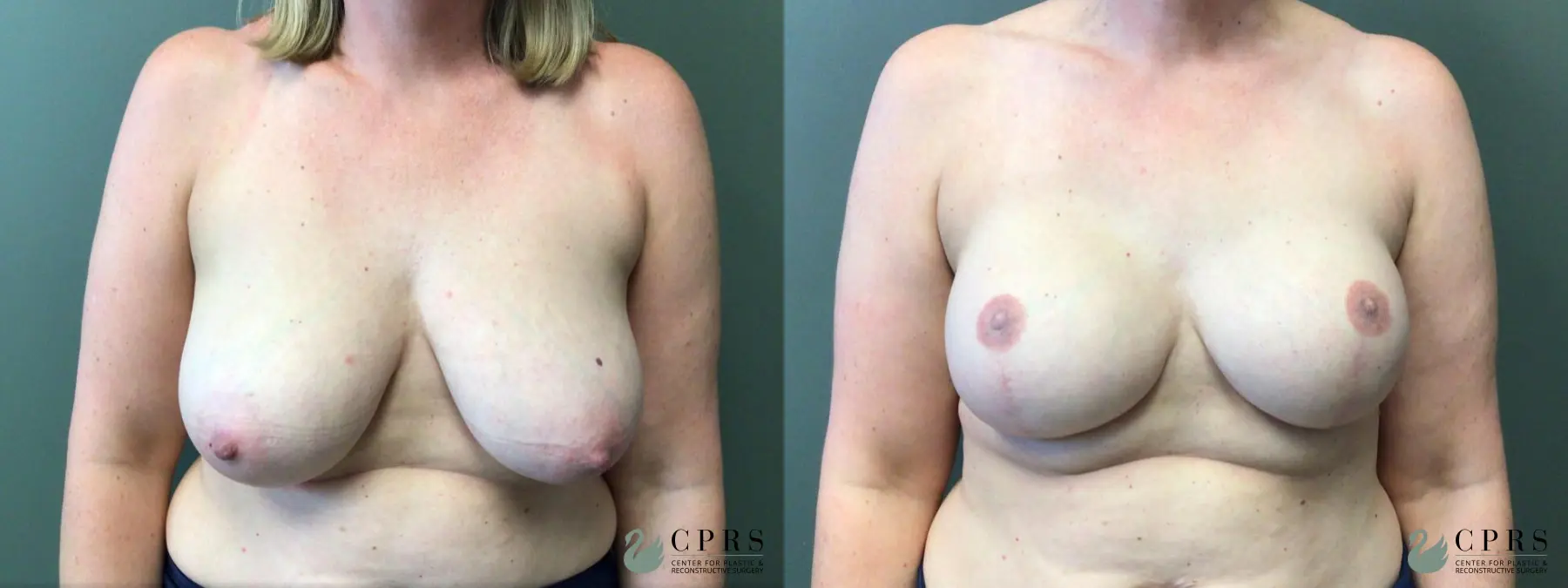 Breast Reconstruction: Patient 2 - Before and After  