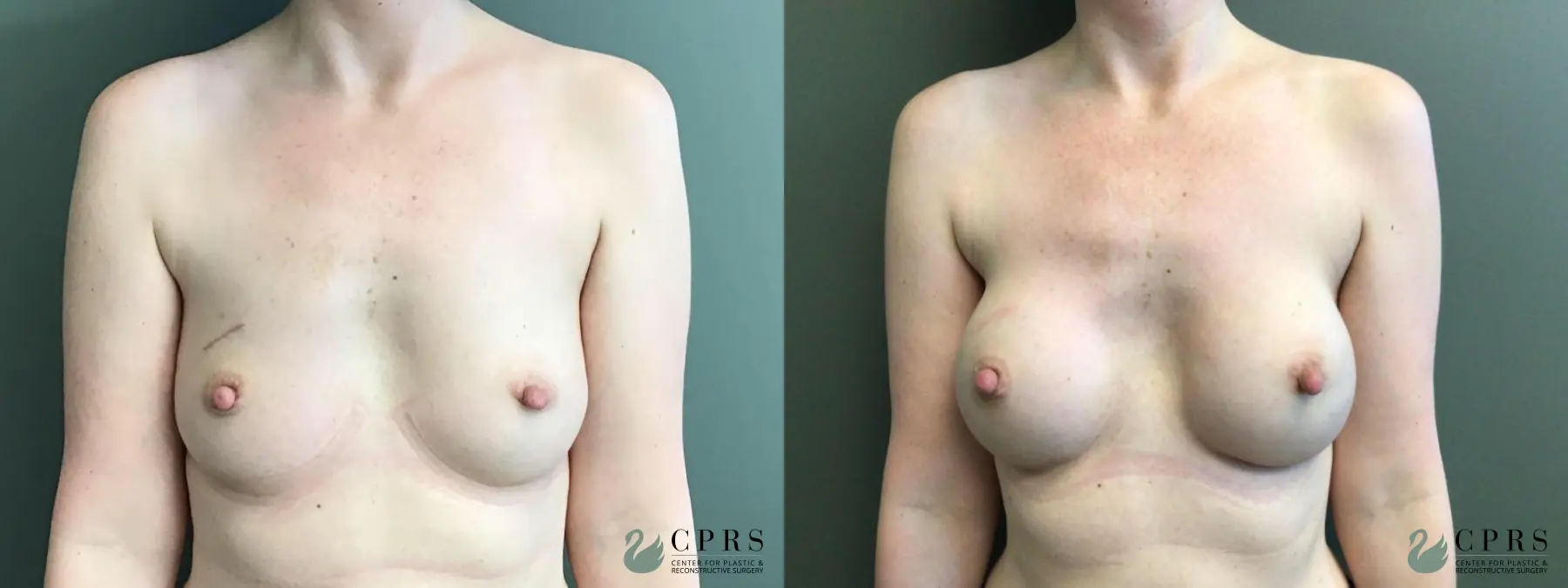 Breast Reconstruction: Patient 5 - Before and After  